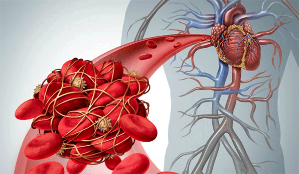Cục máu đông là nguyên nhân gây tắc nghẽn mạch và xuất hiện cơn đau tim